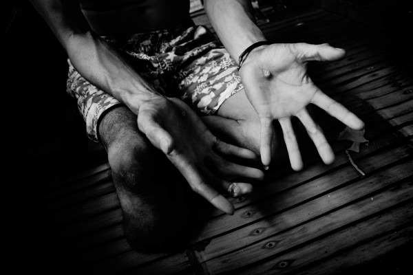 Wilson Manuba shows the tumor-like wounds, attributed to the tailings.